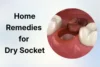 Home Remedies for Dry Socket: Ways to Relieve Pain and Heal - Post Thumbnail