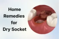 Home Remedies for Dry Socket: Ways to Relieve Pain and Heal