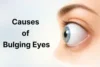 Causes of Bulging Eyes: Why Your Eyes Protrude - Post Thumbnail