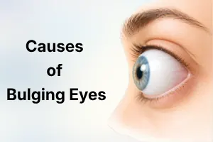 Causes of Bulging Eyes: Why Your Eyes Protrude