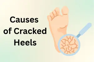 Causes of Cracked Heels: Simple Guide to Main Factors