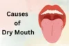 Causes of Dry Mouth: Discover the Reasons Behind Oral Dryness  - Post Thumbnail