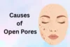 Causes of Open Pores on Face: Reveal the Real Reasons - Post Thumbnail