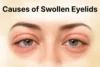 Causes of Swollen Eyelids: Common Reasons You Should Know - Post Thumbnail