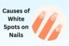 Causes of White Spots on Nails: Is It a Sign of Something Serious? - Post Thumbnail