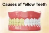 Causes of Yellow Teeth: Common Reasons Behind Tooth Discoloration - Post Thumbnail