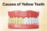 Causes of Yellow Teeth: Common Reasons Behind Tooth Discoloration