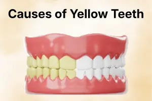 Causes of Yellow Teeth: Common Reasons Behind Tooth Discoloration