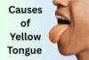 Causes of Yellow Tongue: Common Reasons and When to Worry - Post Thumbnail