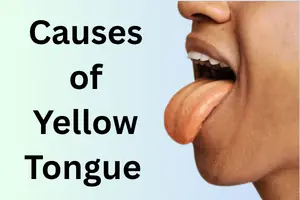 Causes of Yellow Tongue: Common Reasons and When to Worry