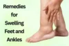 Home Remedies for Swelling Feet and Ankles: Natural Ways to Reduce Swelling - Post Thumbnail