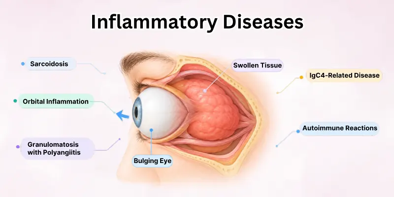 Inflammatory Disease Cause of Bulging Eyes