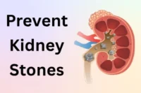 How to Prevent Kidney Stones: Natural and Proven Ways