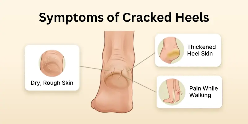 Symptoms of Cracked Heels