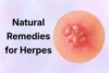 Natural Remedies for Herpes: Reduce Discomfort Naturally - Post Thumbnail
