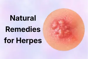 Natural Remedies for Herpes: Reduce Discomfort Naturally
